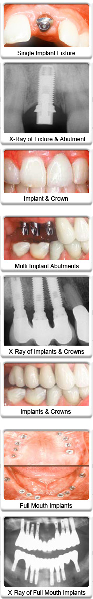 dental implants dental implants