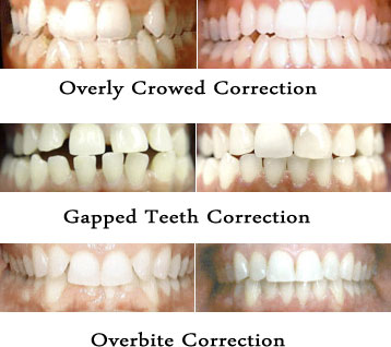 Invisalign Before and After Pictures